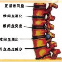 腰椎间盘突出