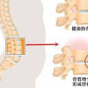 骨质增生
