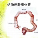 结肠癌