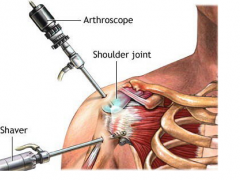 肩关节镜手术