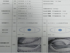 双眼干涩、异物感怎么回事？小心患上“干眼症”