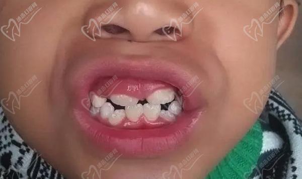 儿童门牙外翻如何矫正？请问孩子的门牙向外翘“飘”能矫正好吗