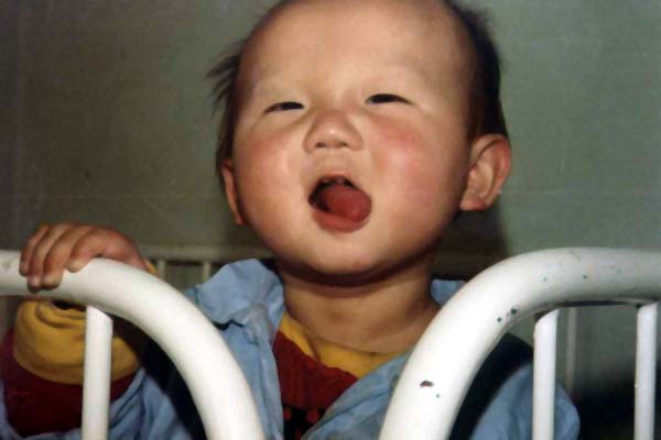 中医望色之天庭紫红
