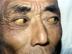 中医望色之面色红黄，阳黄