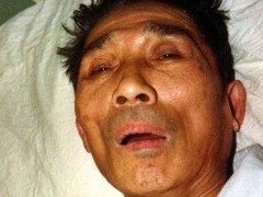 中医望神之无神(昏迷)