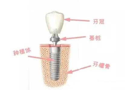 种植牙即拔即种