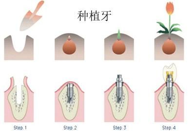 种牙齿多少钱一颗