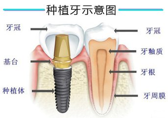 种牙齿的费用组成