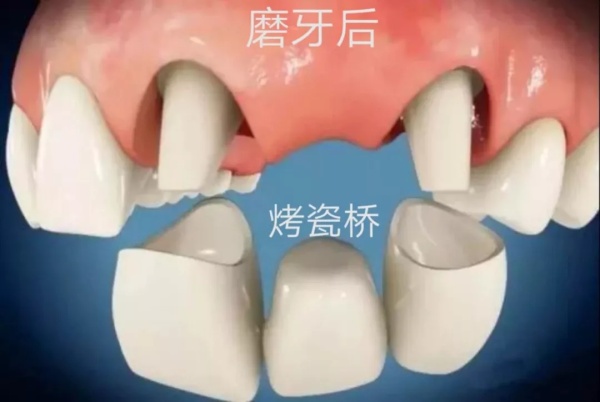 缺失一颗牙磨牙做烤瓷桥