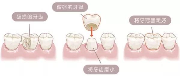 镶牙不种牙