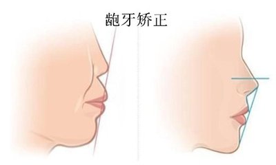 小孩龅牙牙齿矫正