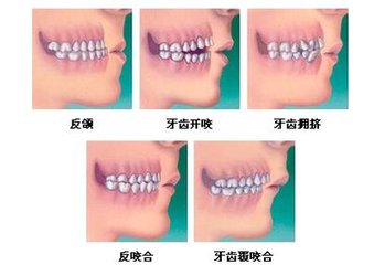 小孩子的爆牙可以拔么