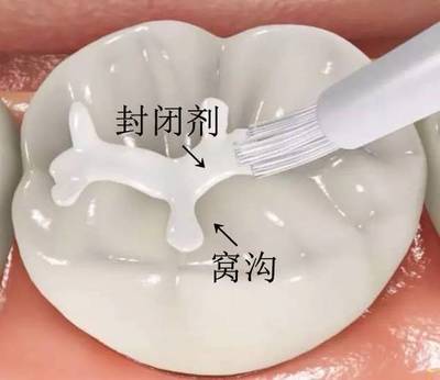 乳牙窝沟封闭的价格