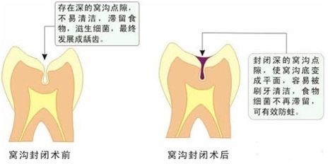 窝沟封闭