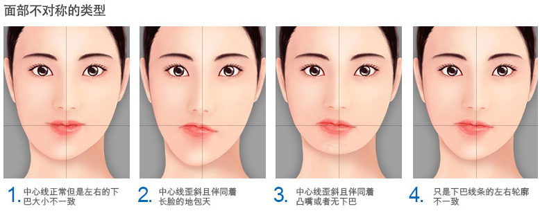 侧颌——脸型不对称