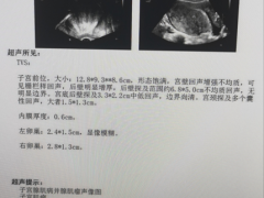 中年女性痛经严重？原来是子宫腺肌症