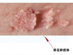 hpv16阳性尖锐湿疣图片