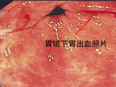 胃出血住院的照片
