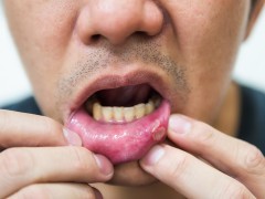 宝宝中性粒细胞低口腔溃疡