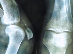 骨关节治关节骨质增生吗