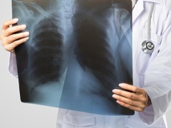 70岁肺大疱自愈最快的方法是什么