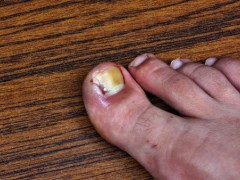 怎么看灰指甲恢复情况