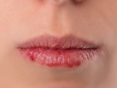 确诊生殖器疱疹吃这些食物好的快 生殖器疱疹患者吃哪些食物好