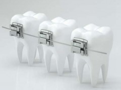 深圳儿童牙齿矫正价格是多少？从牙齿矫正器、牙齿实际情况、医院等级来了解！