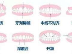 重庆矫正一颗牙需要多少钱？矫正危害科普