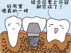 种植牙和烤瓷牙哪个更好一点?长沙种植牙齿价格多少