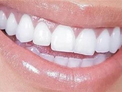 广州柏德口腔医院种植牙齿效果可信吗？耿远明等专家真实实力如何？