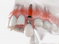 北京诺贝尔种植牙价格多少 ?牙槽骨量、种植体知识科普！