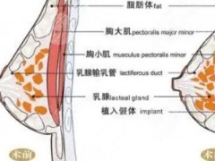 韩国蓓拉假体价格是多少？贵不贵？隆胸效果手感怎么样？