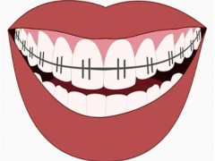 西安牙齿矫正多少钱?附术后如何护理~