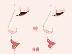 上海玻尿酸隆鼻价格贵吗 ？上海九院/上海同济等收费公道！