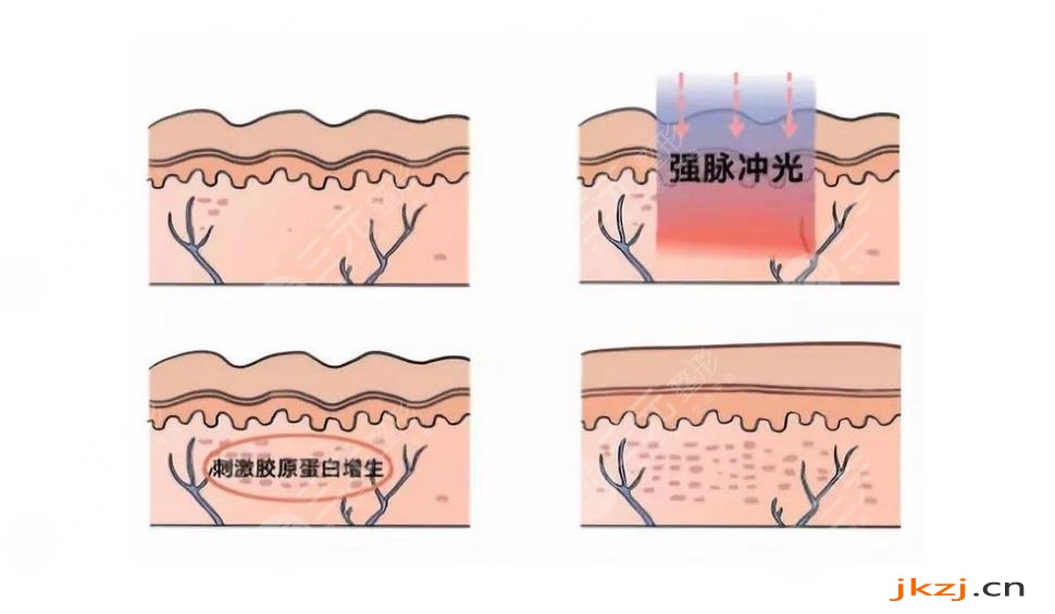 光子嫩肤手术一次需要多长时间?