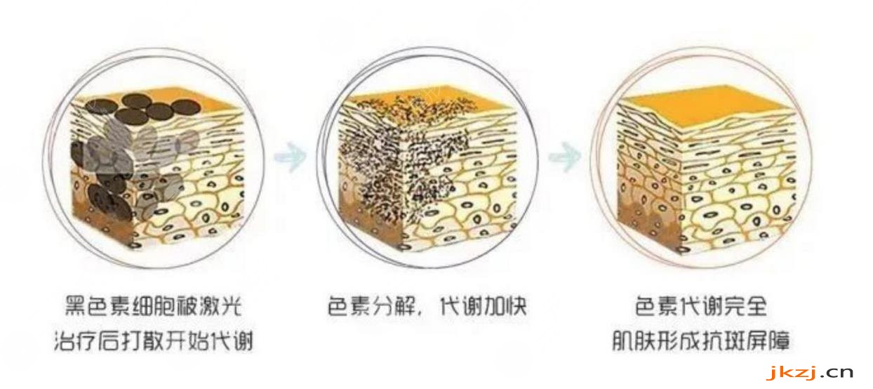 激光祛斑的护理方法