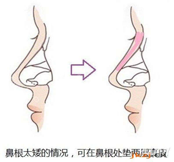 赣州市立医院烧伤整形科科普隆鼻手术知识