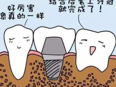 佛山种一颗牙大概要多少钱？三大价格影响因素盘点/种植牙品牌