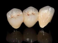 福州种牙推荐！4家正规口腔门诊可比较价钱，维乐、登特等性价比高！