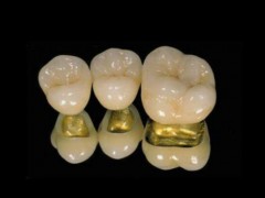 大连哪个医院种牙效果好？详细介绍+术后恢复示例图片