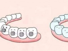 兰州牙齿矫正一般多少钱