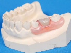 昆明补牙的价格和方法，一颗大概需要多少钱？补牙的优势是什么？